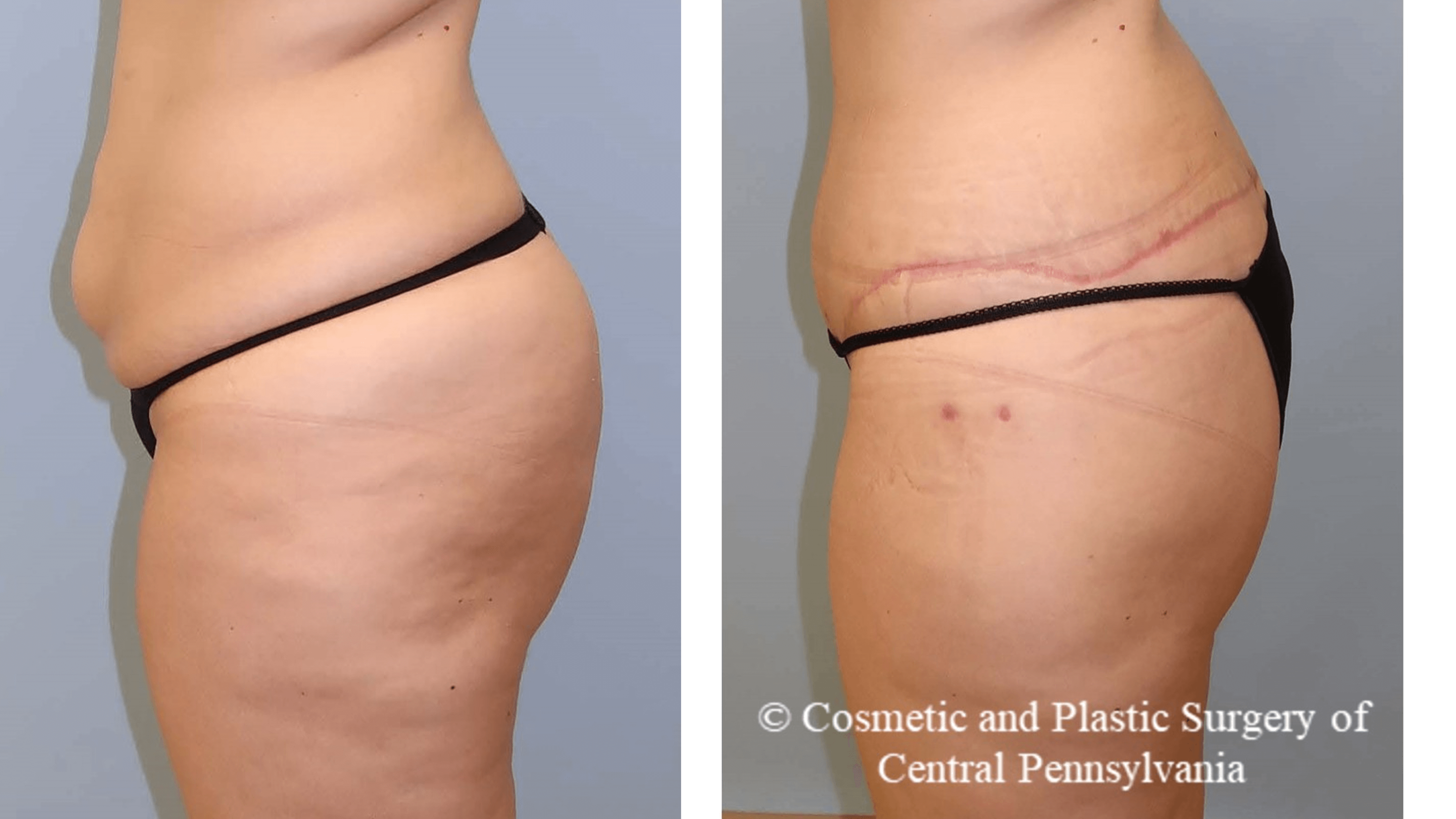 circumferential lower body lif